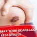 How to Make Your Scars Look Less Visible